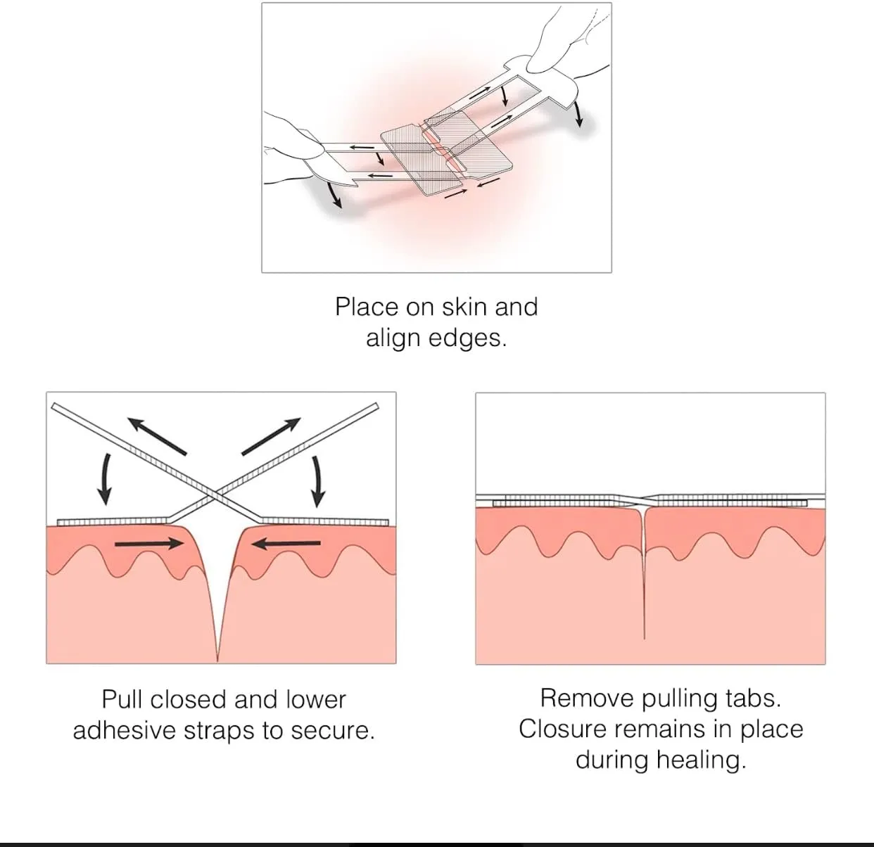 ITEM# 0210   Emergency Laceration Kit - Repair Wounds Without Stitches. FDA Cleared Skin Closure Device for a Wound Up to 1 1/2 Inches in Length. Complete Kit to Clean, Close, and Cover Wounds. (Watch Video)